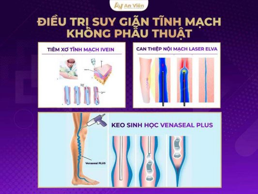 các phương pháp điều trị suy giãn tĩnh mạch n