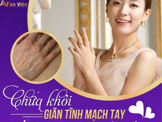 chữa trị giãn tĩnh mạch tay
