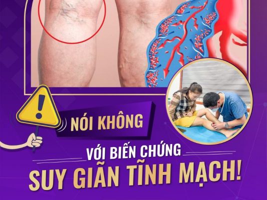 Đừng để loét chân do giãn tĩnh mạch