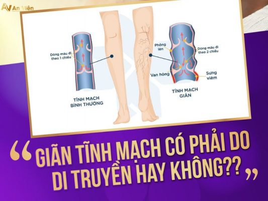 Giãn tĩnh mạch có di truyền không