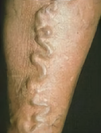 Suy giãn tĩnh mạch cấp độ 2