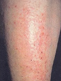 Suy giãn tĩnh mạch cấp độ 4