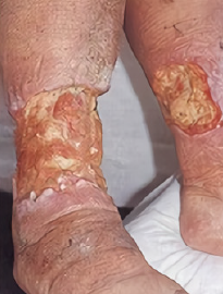 Suy giãn tĩnh mạch cấp độ 6