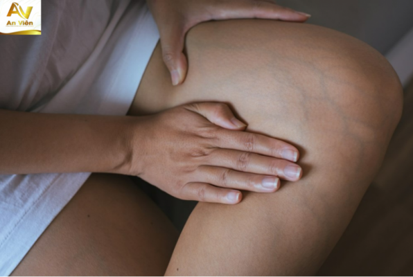 Phụ nữ mang thai bị suy giãn tĩnh mạch