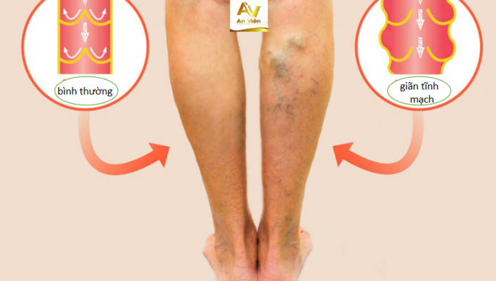 Hình ảnh: giãn tĩnh mạch ảnh hưởng đến sức khỏe