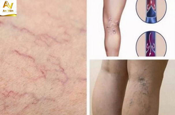 Phương pháp điều trị không phẫu thuật-laser nội mạch