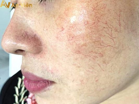 Suy giãn tĩnh mạch ở mặt xuất hiện mạch máu li ti