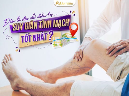 Chữa suy giãn tĩnh mạch ở đâu tốt nhất