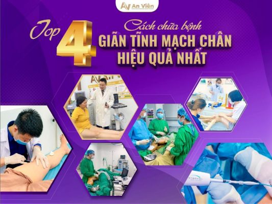 cách chữa bệnh giãn tĩnh mạch chân
