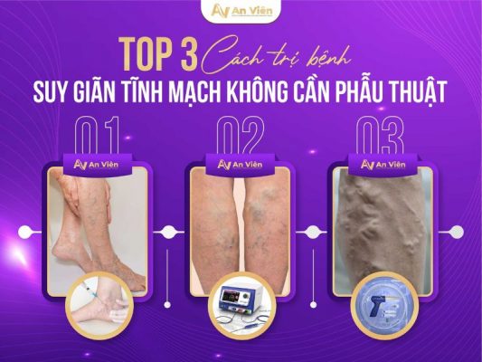 cách trị bệnh suy giãn tĩnh mạch