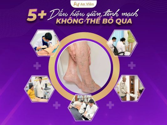 dấu hiệu của giãn tĩnh mạch