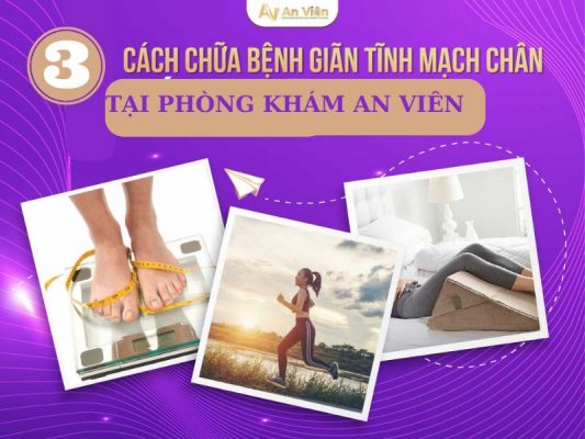 giãn tĩnh mạch và cách điều trị
