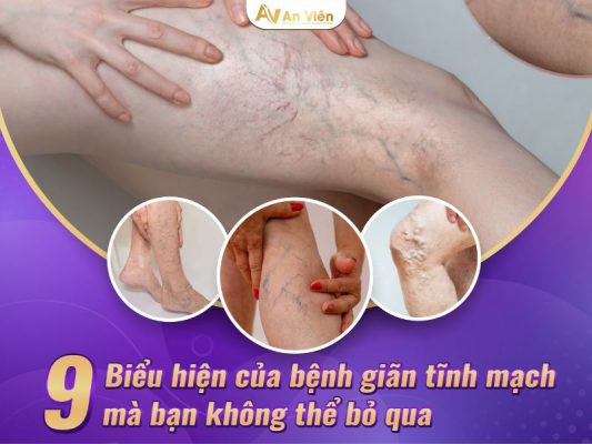 biểu hiện của bệnh giãn tĩnh mạch