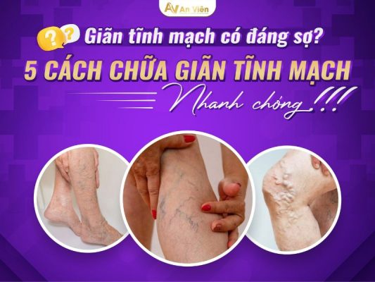 cách chữa giãn tĩnh mạch