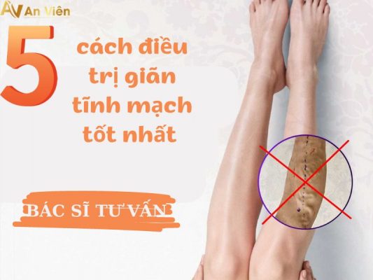 cách điều trị giãn tĩnh mạch
