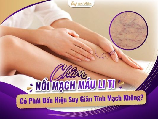 chân bị nổi mạch máu