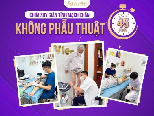 chữa giãn tĩnh mạch chân