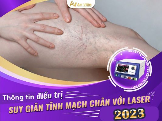 điều trị giãn tĩnh mạch chân