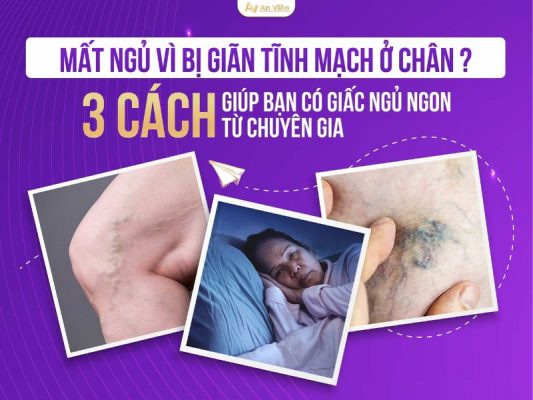 giãn tĩnh mạch ở chân