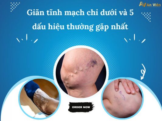 hiện tượng giãn tĩnh mạch chân