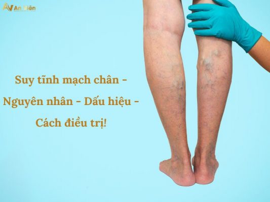 suy tĩnh mạch chân