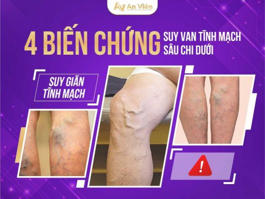suy van tĩnh mạch sâu chi dưới