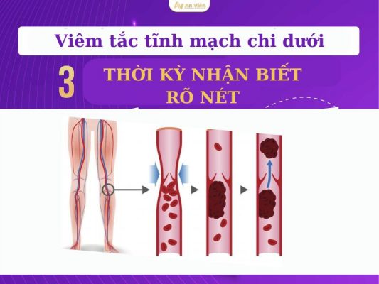 tắc tĩnh mạch chi dưới