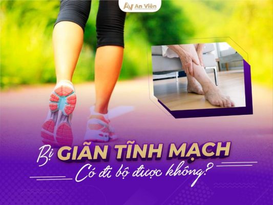 bị giãn tĩnh mạch có đi bộ được không