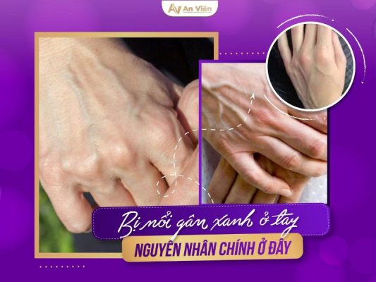 bị nổi gân xanh ở tay