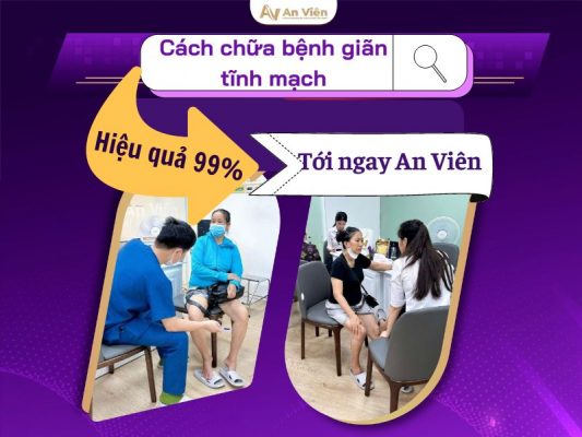 cách chữa bệnh giãn tĩnh mạch