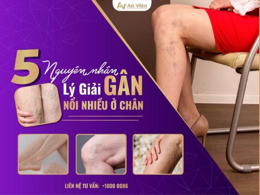 gân nổi nhiều ở chân