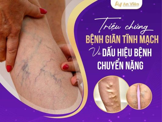 triệu chứng bệnh giãn tĩnh mạch