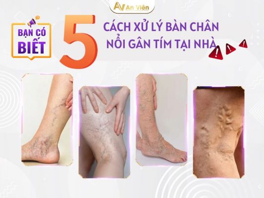 bàn chân nổi gân tím