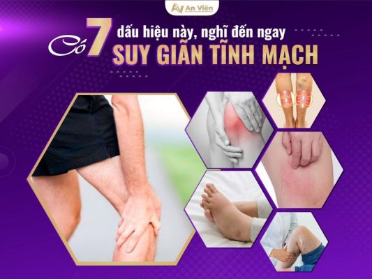 giãn tĩnh mạch