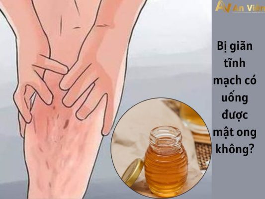 giãn tĩnh mạch có uống được mật ong không