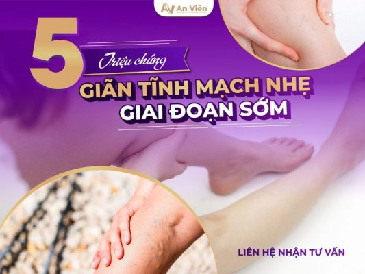 giãn tĩnh mạch nhẹ