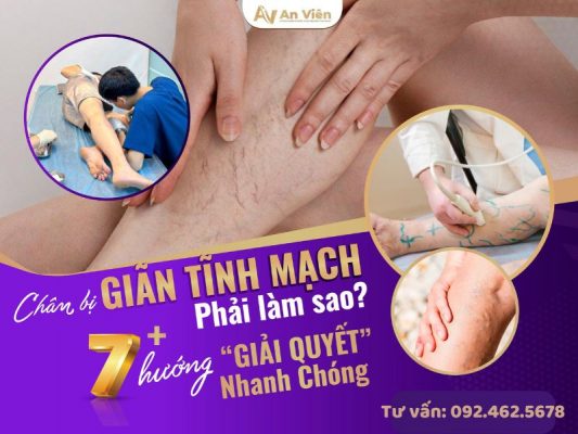chân bị giãn tĩnh mạch phải làm sao
