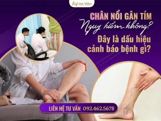 chân nổi gân tím