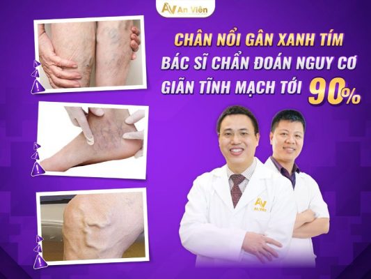 chân nổi gân xanh tím