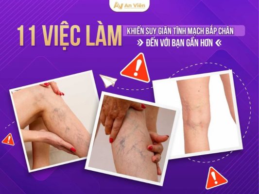 suy giãn tĩnh mạch bắp chân