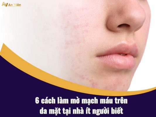 cách làm mờ mạch máu trên da mặt