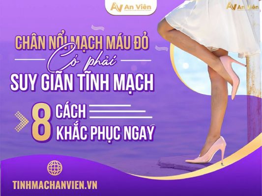 chân nổi mạch máu đỏ