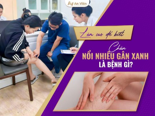 chân nổi gân xanh là bệnh gì