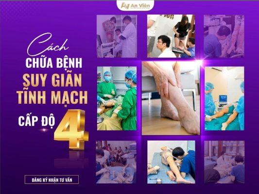 chữa bệnh suy giãn tĩnh mạch