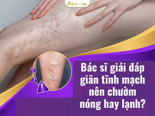 Giãn tĩnh mạch chườm nóng hay lạnh