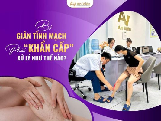 bị giãn tĩnh mạch ở chân phải làm sao
