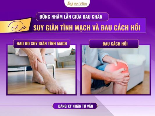 đau chân do giãn tĩnh mạch
