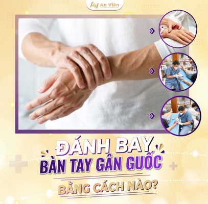 giãn tĩnh mạch tay 1
