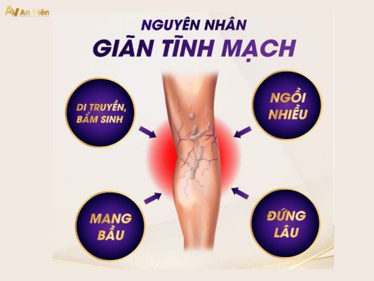 nguyên nhân giãn tĩnh mạch