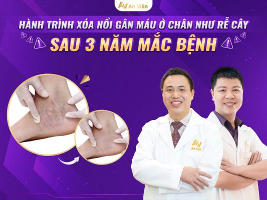 nổi gân máu ở chân